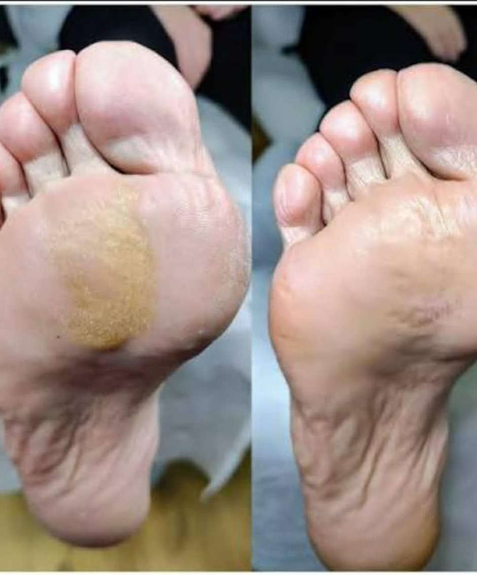 leczenie modzeli w Gabinecie Kosmetyczno - Podologicznym Maria
            w Gnieźnie