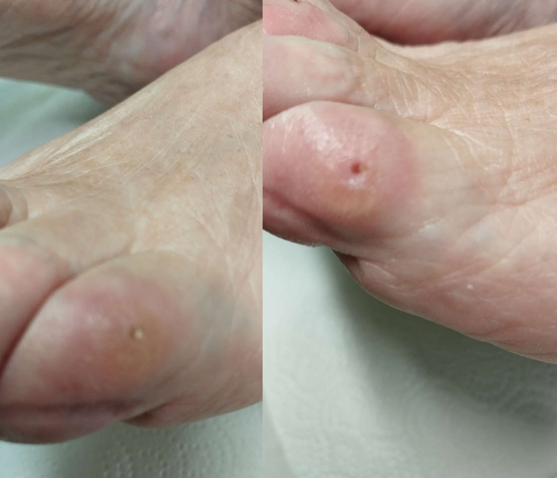 leczenie odcisków w Gabinecie Kosmetyczno - Podologicznym Maria
            w Gnieźnie