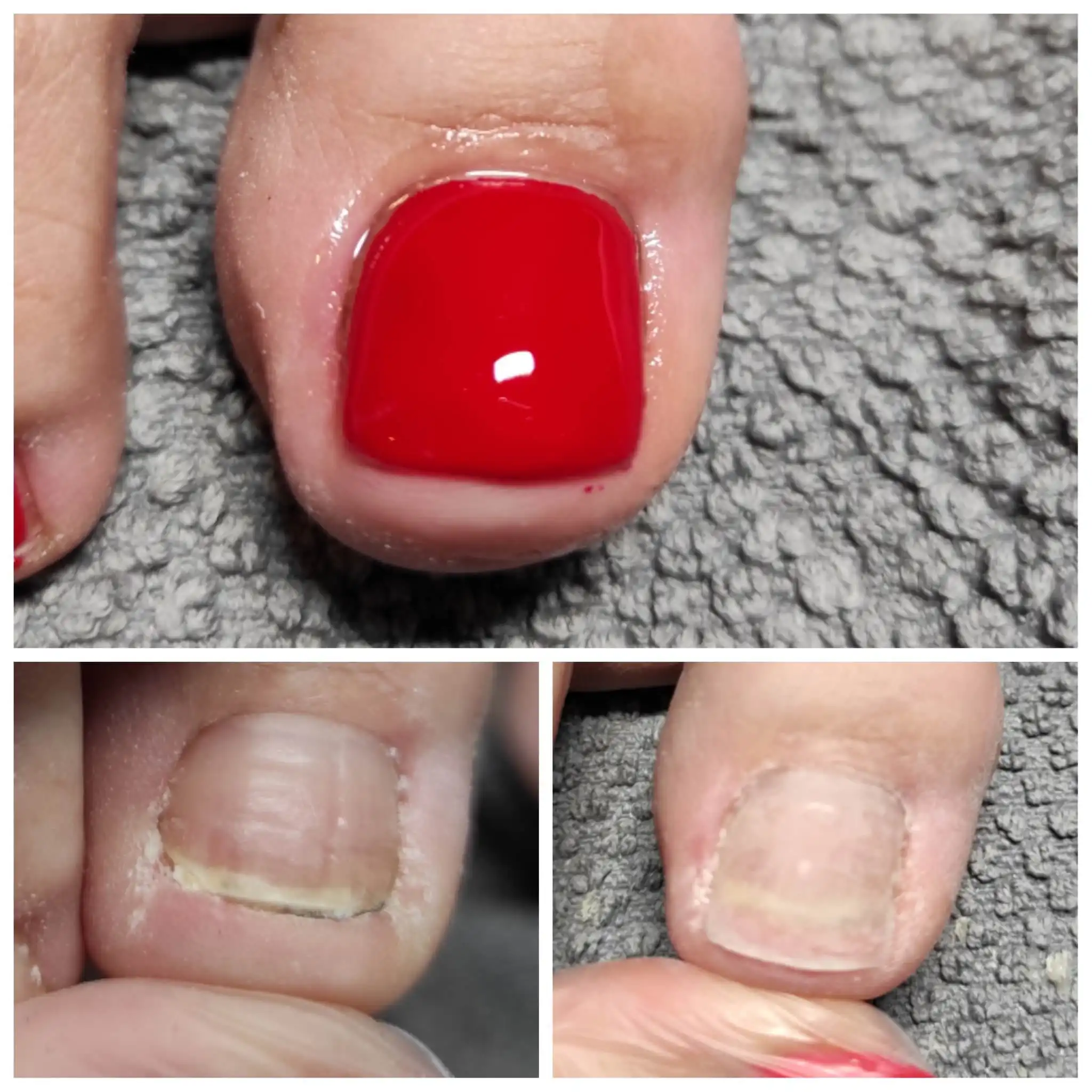 paznokcie stóp w Gabinecie Kosmetyczno-Podologicznym Maria w Gnieźnie